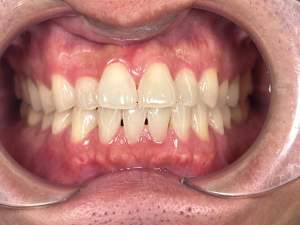 Smile transformation case 6 — before treatment