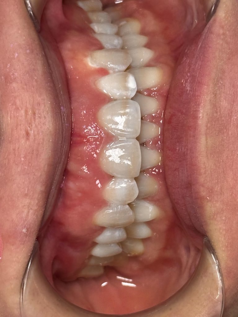 Smile transformation case 3 — after treatment