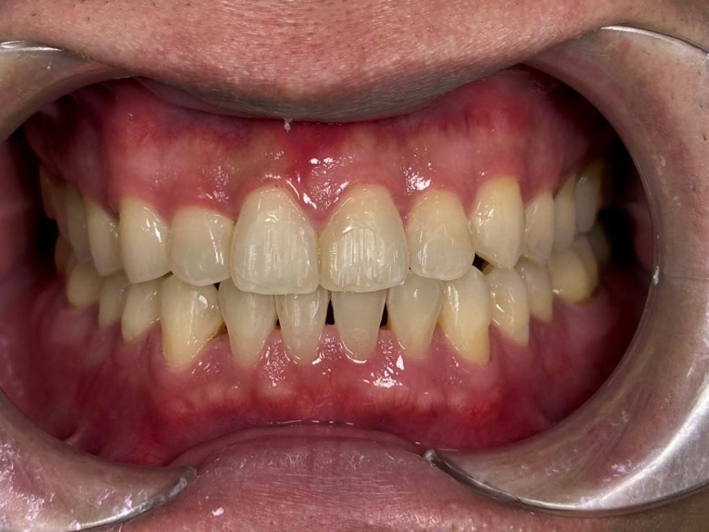 Smile transformation case 6 — after treatment